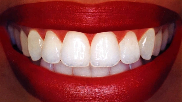 Unlock Your Brightest Smile: Discover the Secrets of Teeth Whitening